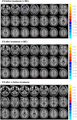 Changes of regional brain activity following Tuina therapy for patients with painful cervical spondylosis: a resting-state fMRI study